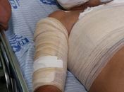 Aparelho celular explode e fere policial militar em Campo Alegre
