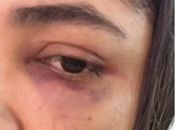 Vítima foi agredida com socos no olho