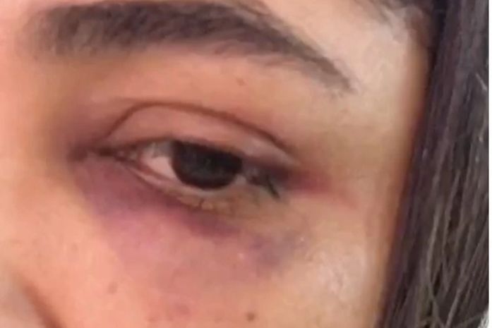 Vítima foi agredida com socos no olho