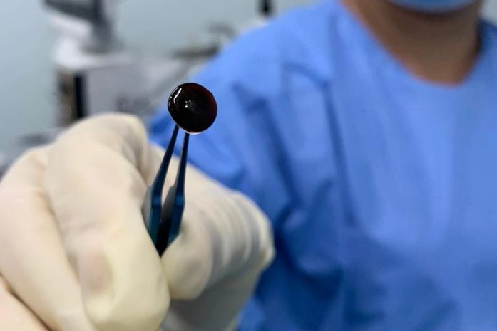 Paciente do Instituto da Visão foi operada com o tipo mais avançado de catarata