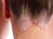 Dia Mundial da Psoríase: Diversos mitos ainda rondam a doença, afirma dermatologista