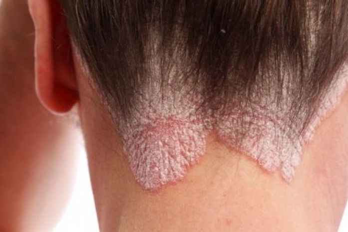 Dia Mundial da Psoríase: Diversos mitos ainda rondam a doença, afirma dermatologista