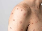Mpox