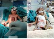 Bebê que nasceu com coração fora do peito passa por cirurgia na Índia