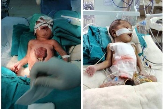 Bebê que nasceu com coração fora do peito passa por cirurgia na Índia