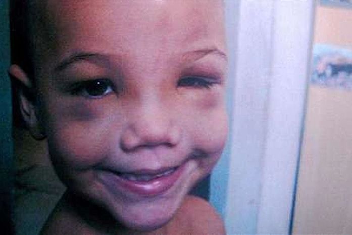 Menino espancado por padrasto morre em hospital de Volta Redonda
