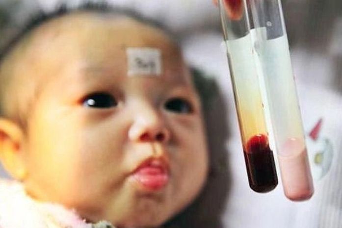 Bebê com sangue cor-de-rosa surpreende médicos na China