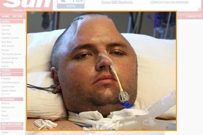 Cirurgiões salvam paciente após guardar crânio no congelador