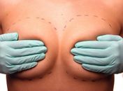 Próteses de silicone exigem atenção por parte da mulher