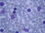 Imagem de amostra de sangue com células infectadas e doentes 