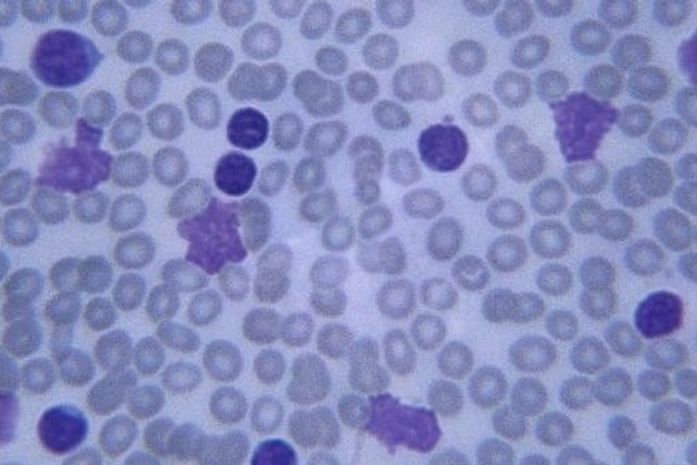 Imagem de amostra de sangue com células infectadas e doentes
