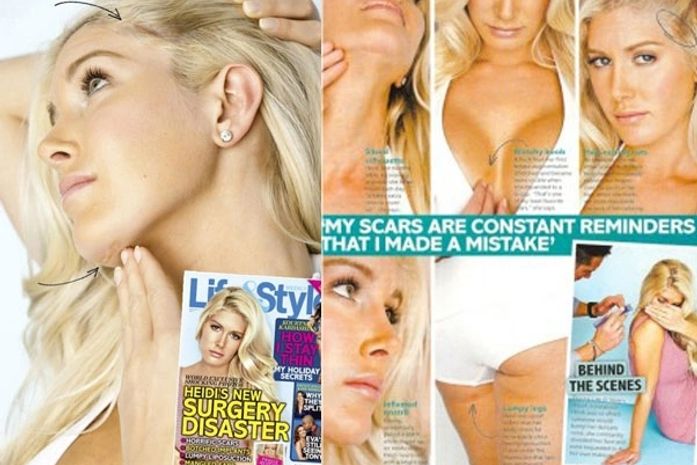 Após dez cirurgias, Heidi Montag exibe muitas cicatrizes