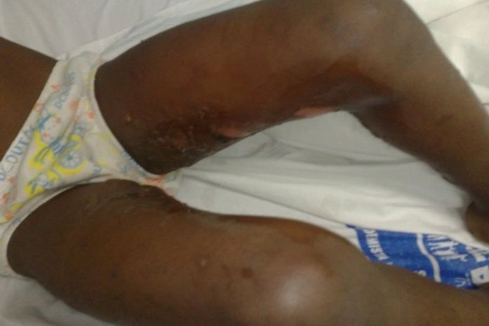 Criança deve várias queimaduras pelo corpo