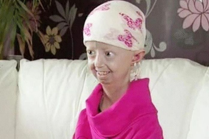 Menina com envelhecimento precoce consegue chegar aos 13 anos