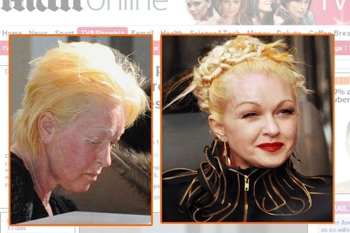 Com a pele descamando, Cyndi Lauper aparece irreconhecível nos EUA