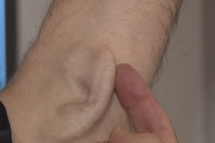 Artista de origem grega implanta orelha no próprio braço