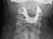 Homem fica oito dias com dentadura 'perdida' na garganta após cirurgia