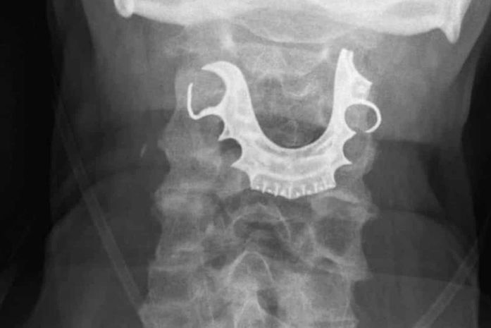 Homem fica oito dias com dentadura 'perdida' na garganta após cirurgia