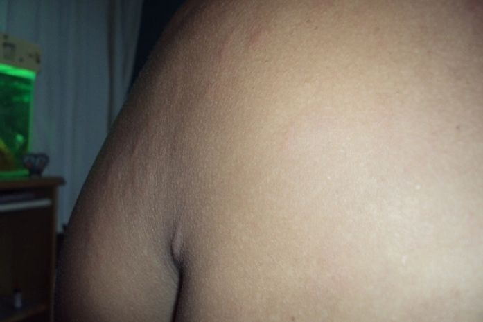 Aparecida ficou com o corpo cheido de caroços