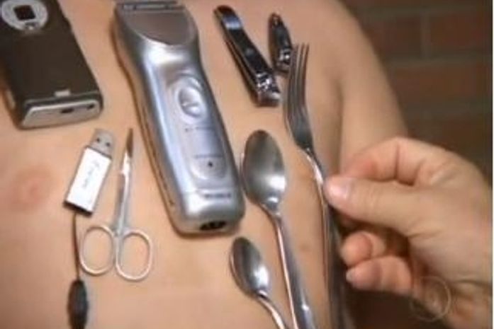 Menino de 11 anos atrai objetos metálicos ao corpo no RN