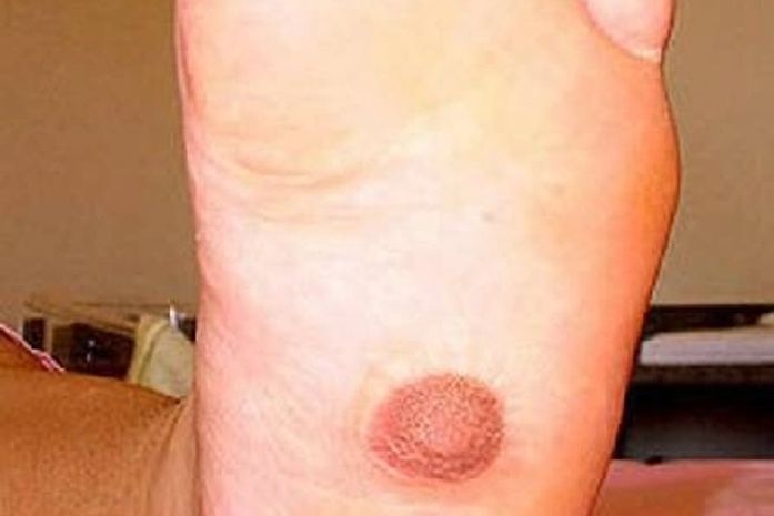 Mulher tem terceiro mamilo na sola do pé