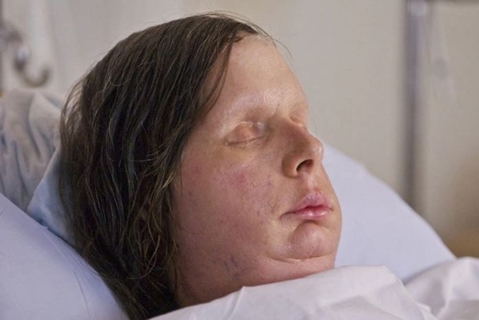 Nova face de mulher desfigurada após ataque de chimpanzé é revelada