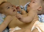 Gêmeas siamesas são separadas na China