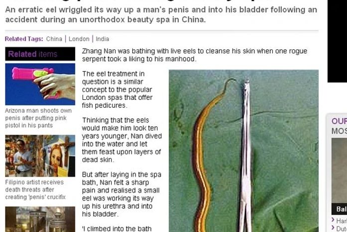Enguia que havia entrado na uretra de Zhang Nan