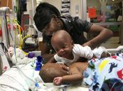 Gêmeos siameses se abraçam após cirurgia de 13 horas nos EUA