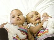 Gêmeas siamesas unidas pela cabeça são separadas em Londres