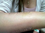 Estudante tem braço quebrado após recusar beijo em boate no RN