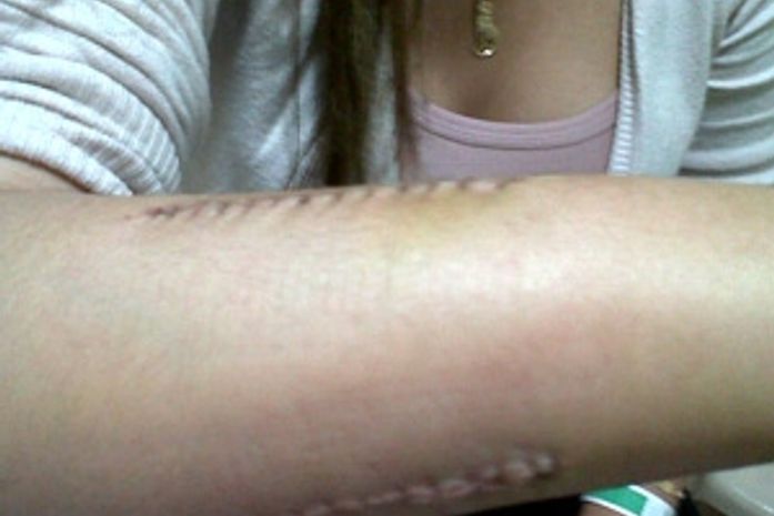 Estudante tem braço quebrado após recusar beijo em boate no RN