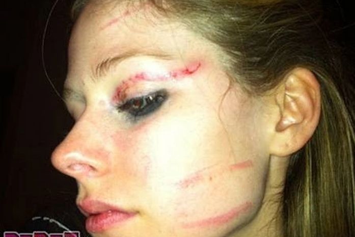Avril, após ser agredida por cinco pessoas em um hotel de Hollywood