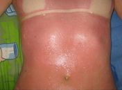 Em MS, jovem denuncia clínica após queimaduras em bronzeamento