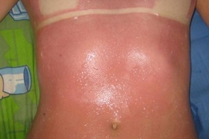 Em MS, jovem denuncia clínica após queimaduras em bronzeamento