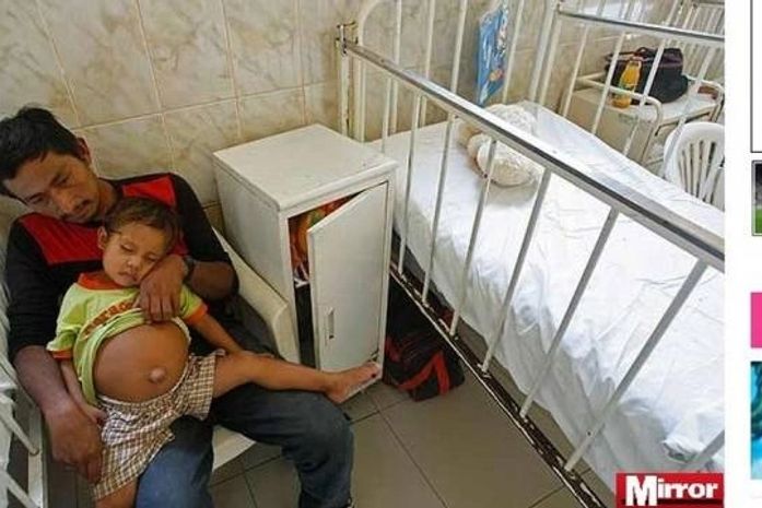 Médicos do Peru descobrem feto de 25 cm no abdômen de menino de três ano