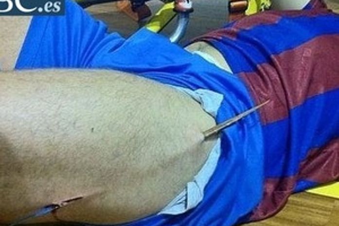 Atleta espanhol tem coxa perfurada por pedaço de madeira durante jogo