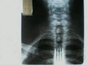 Homem engole garfo após tentar coçar a garganta com o objeto no PR