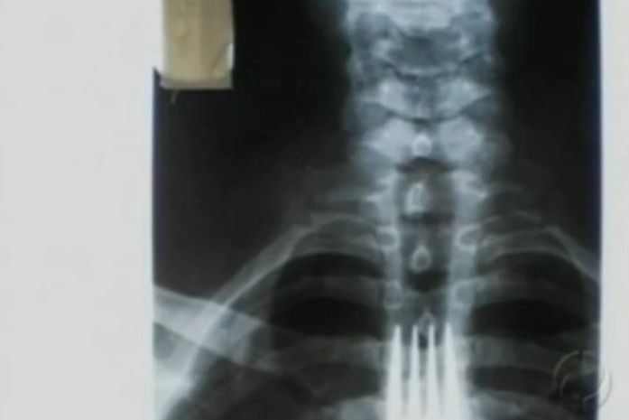 Homem engole garfo após tentar coçar a garganta com o objeto no PR