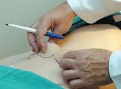 Em Alagoas, especialista alerta para cuidados ao se submeter a cirurgia plástica
