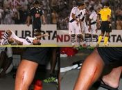 A perna esquerda de Diego Souza e as marcas ignoradas pelo árbitro chileno