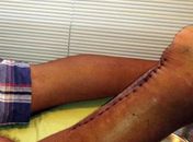 Adriano trocou o primeiro curativo na quarta-feira