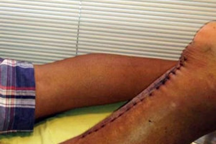 Adriano trocou o primeiro curativo na quarta-feira