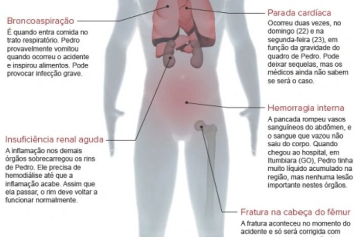 Médicos de SP vão a Goiânia avaliar transferência do cantor Pedro