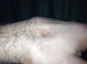 Mão fraturada de Vitor Belfort.
