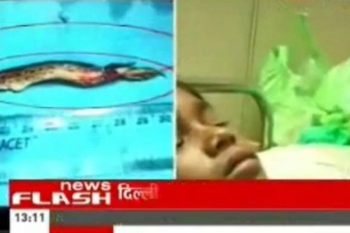 Menino indiano passa por cirurgia após peixe de 9 cm ir parar no pulmão