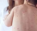 Em seis meses, Alagoas registra 7 casos de meningite e Sesau reforça medidas de prevenção 