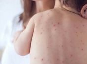 Em seis meses, Alagoas registra 7 casos de meningite e Sesau reforça medidas de prevenção 