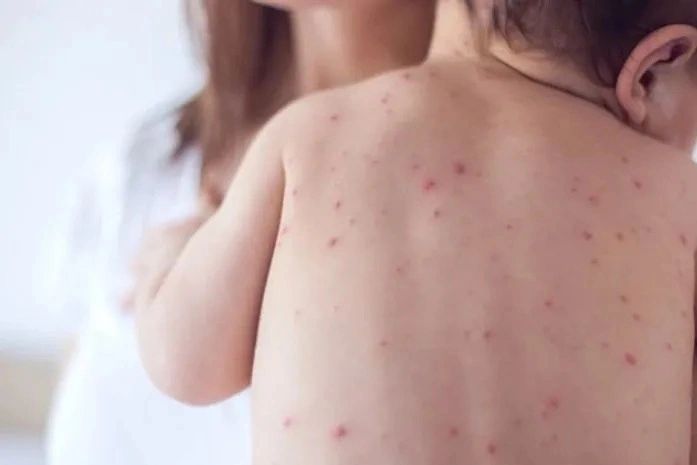 Em seis meses, Alagoas registra 7 casos de meningite e Sesau reforça medidas de prevenção 