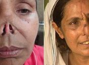 Paquistanesa atacada por marido diz ter nascido de novo com reconstrução de nariz